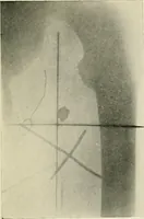 An illustration from Localization by X-rays and stereoscopy (1916)