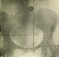 An illustration from Localization by X-rays and stereoscopy (1916)