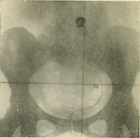 An illustration from Localization by X-rays and stereoscopy (1916)