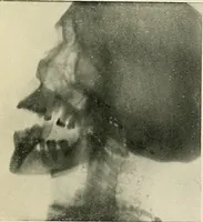 An illustration from Localization by X-rays and stereoscopy (1916)