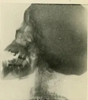 An illustration from Localization by X-rays and stereoscopy (1916)