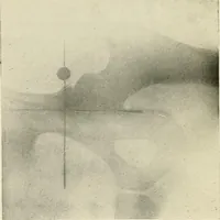 An illustration from Localization by X-rays and stereoscopy (1916)