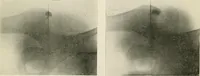 An illustration from Localization by X-rays and stereoscopy (1916)