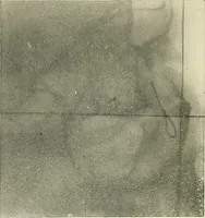 An illustration from Localization by X-rays and stereoscopy (1916)