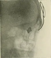 An illustration from Localization by X-rays and stereoscopy (1916)