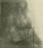 An illustration from Localization by X-rays and stereoscopy (1916)
