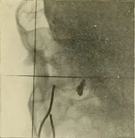 An illustration from Localization by X-rays and stereoscopy (1916)