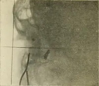 An illustration from Localization by X-rays and stereoscopy (1916)