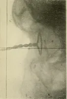 An illustration from Localization by X-rays and stereoscopy (1916)