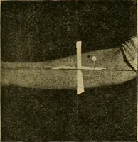 An illustration from Localization by X-rays and stereoscopy (1916)