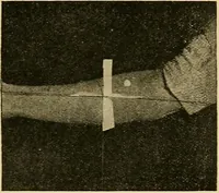 An illustration from Localization by X-rays and stereoscopy (1916)
