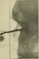 An illustration from Localization by X-rays and stereoscopy (1916)