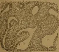 An illustration from Manual de anatomía patológica general : seguida de un resumen de microscopia aplicada a la histología y bacteriología patológicas (1896)