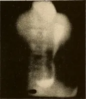 An illustration from A manual of X-ray technic (1917)
