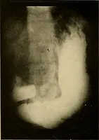 Picture 22 of 41 from A manual of X-ray technic (1917), leaf 123