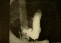 An illustration from A manual of X-ray technic (1917)