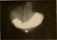 Picture 24 of 41 from A manual of X-ray technic (1917), leaf 124