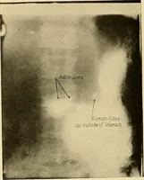 Picture 26 of 41 from A manual of X-ray technic (1917), leaf 125