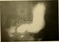 Picture 27 of 41 from A manual of X-ray technic (1917), leaf 125