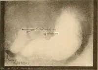Picture 28 of 41 from A manual of X-ray technic (1917), leaf 126