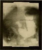 Picture 30 of 41 from A manual of X-ray technic (1917), leaf 127