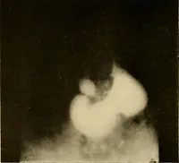 An illustration from A manual of X-ray technic (1917)
