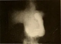 An illustration from A manual of X-ray technic (1917)