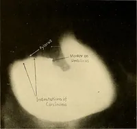 Picture 33 of 41 from A manual of X-ray technic (1917), leaf 133