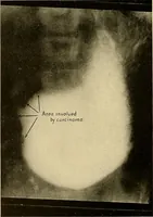 Picture 34 of 41 from A manual of X-ray technic (1917), leaf 133