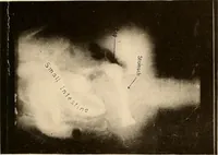 Picture 35 of 41 from A manual of X-ray technic (1917), leaf 134