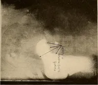 An illustration from A manual of X-ray technic (1917)
