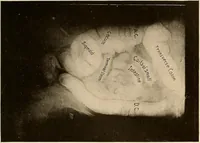 Picture 37 of 41 from A manual of X-ray technic (1917), leaf 142