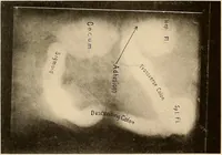 Picture 38 of 41 from A manual of X-ray technic (1917), leaf 142