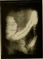 Picture 39 of 41 from A manual of X-ray technic (1917), leaf 143