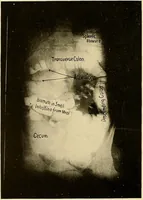 Picture 40 of 41 from A manual of X-ray technic (1917), leaf 143
