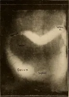 Picture 41 of 41 from A manual of X-ray technic (1917), leaf 144