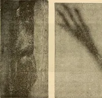 Picture 41 of 52 from Manuel de radioscopie et de radiographie par l'emploi des rayons X (1900), leaf 76
