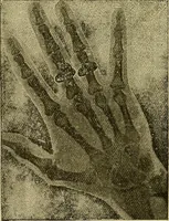 An illustration from Manuel de radioscopie et de radiographie par l'emploi des rayons X (1900)