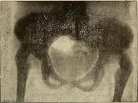 Picture 50 of 52 from Manuel de radioscopie et de radiographie par l'emploi des rayons X (1900), leaf 90