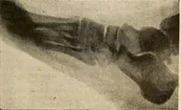 An illustration from Manuel de radioscopie et de radiographie par l'emploi des rayons X (1900)
