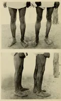 An illustration from Medical observations on the Zuñi Indians (1924)