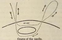 An illustration from The Medical and surgical reporter (1858)