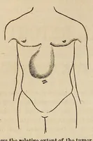 An illustration from The Medical and surgical reporter (1858)