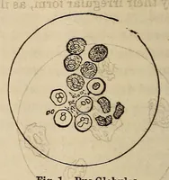 An illustration from The Medical and surgical reporter (1858)