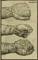 An illustration from Hieronymi Mercvrialis De arte gymnastica libri sex : in quibus exercitationum omnium vetustarum genera, loca, modi, facultates, & quidquid deniq. ad corporis humani exercitationes pertinet, diligenter explicatur .. (1573)