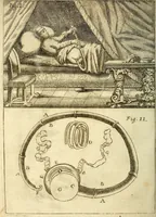Picture 13 of 21 from Michaelis Bernhardi Valentini prof. medici ... Polychresta exotica in curandis affectibus contumacissimis probatissima ... : ut et nova herniarum cura. Accedunt seorsim olim editae ... Dissertationes epistolicae varii argumenti .. (1700), leaf 105