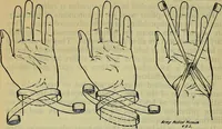 An illustration from Military surgery of the zone of the advance (1918)