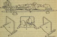 An illustration from Military surgery of the zone of the advance (1918)