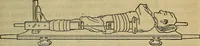 An illustration from Military surgery of the zone of the advance (1918)