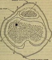 An illustration from Military surgery of the zone of the advance (1918)